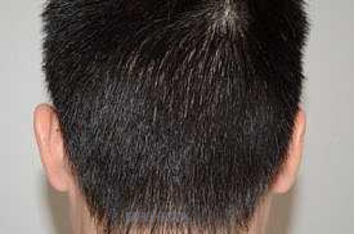 Before & After Hair Transplants For Men Case 100 View 3 View in Miami, FL