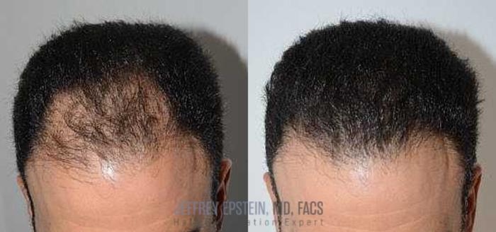 Before & After Hair Transplants For Men Case 102 View 1 View in Miami, FL