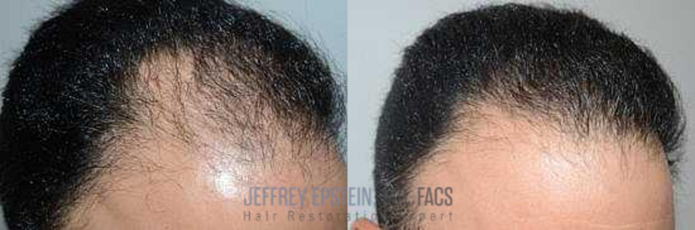 Before & After Hair Transplants For Men Case 102 View 2 View in Miami, FL