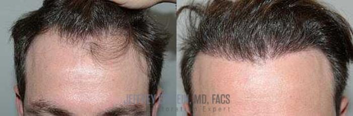 Before & After Hair Transplants For Men Case 103 View 1 View in Miami, FL
