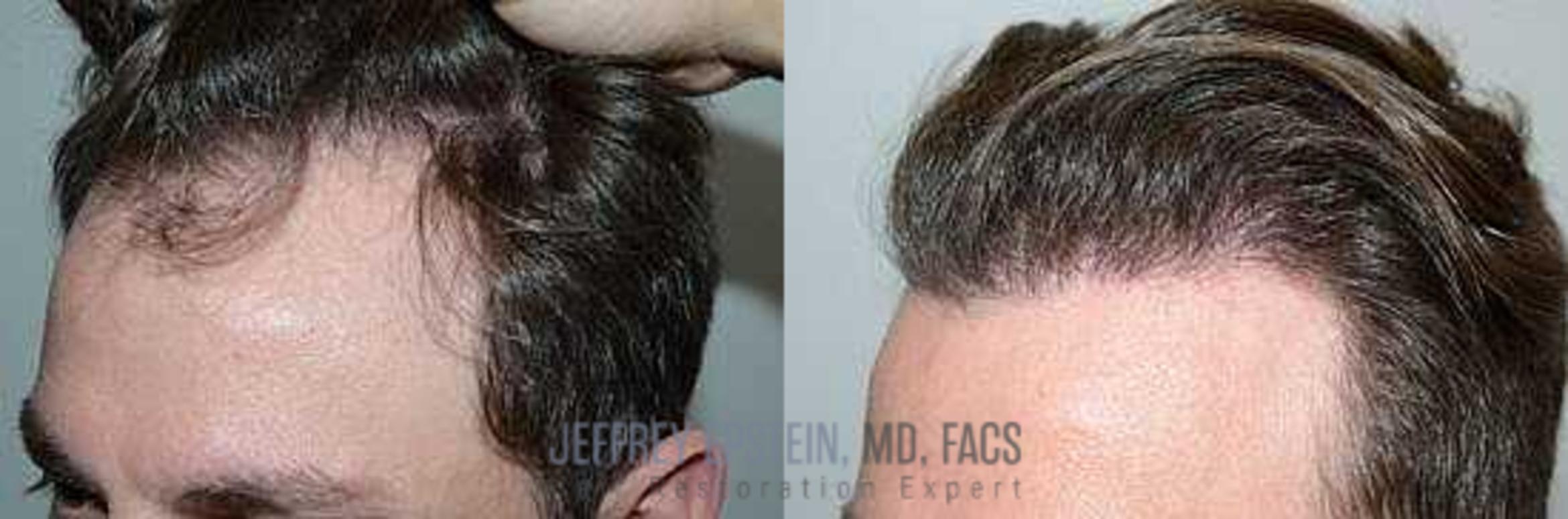 Before & After Hair Transplants For Men Case 103 View 2 View in Miami, FL