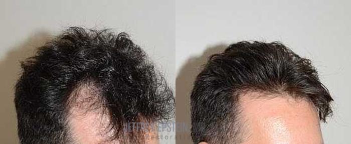 Before & After Hair Transplants For Men Case 104 View 1 View in Miami, FL
