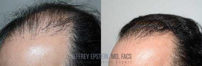 Before & After Hair Transplants For Men Case 105 View 1 View in Miami, FL
