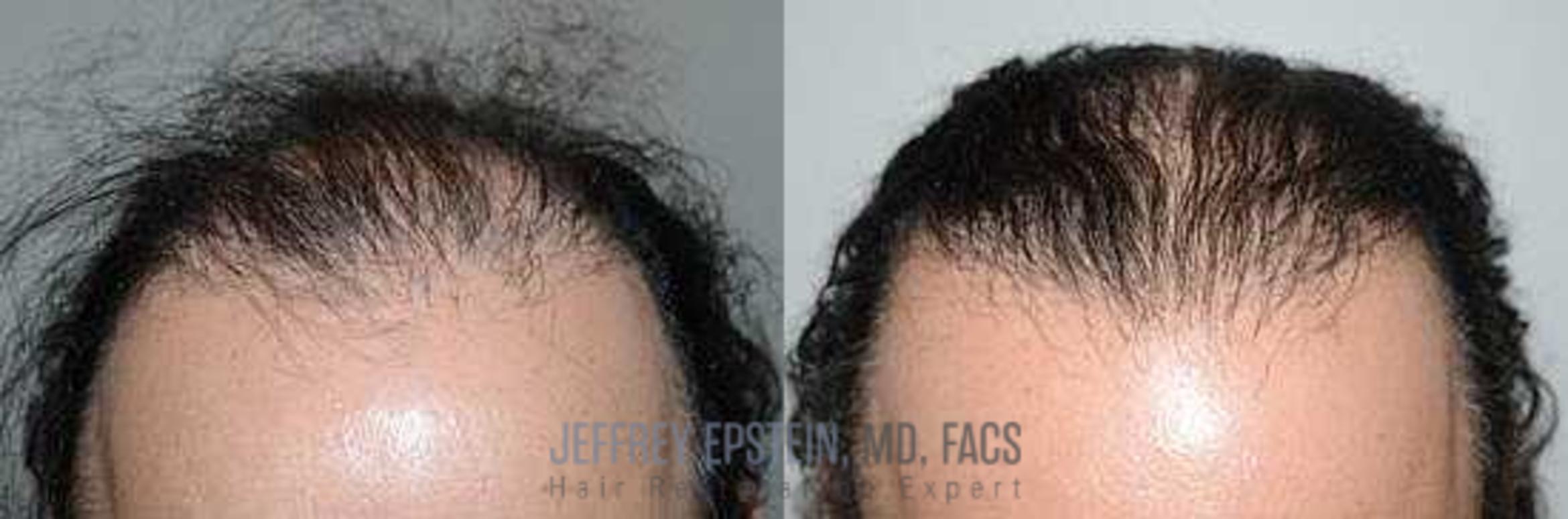 Before & After Hair Transplants For Men Case 105 View 2 View in Miami, FL