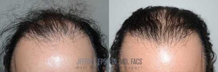 Before & After Hair Transplants For Men Case 105 View 2 View in Miami, FL