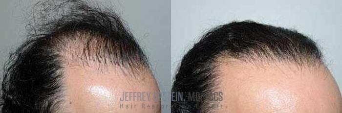 Before & After Hair Transplants For Men Case 105 View 3 View in Miami, FL