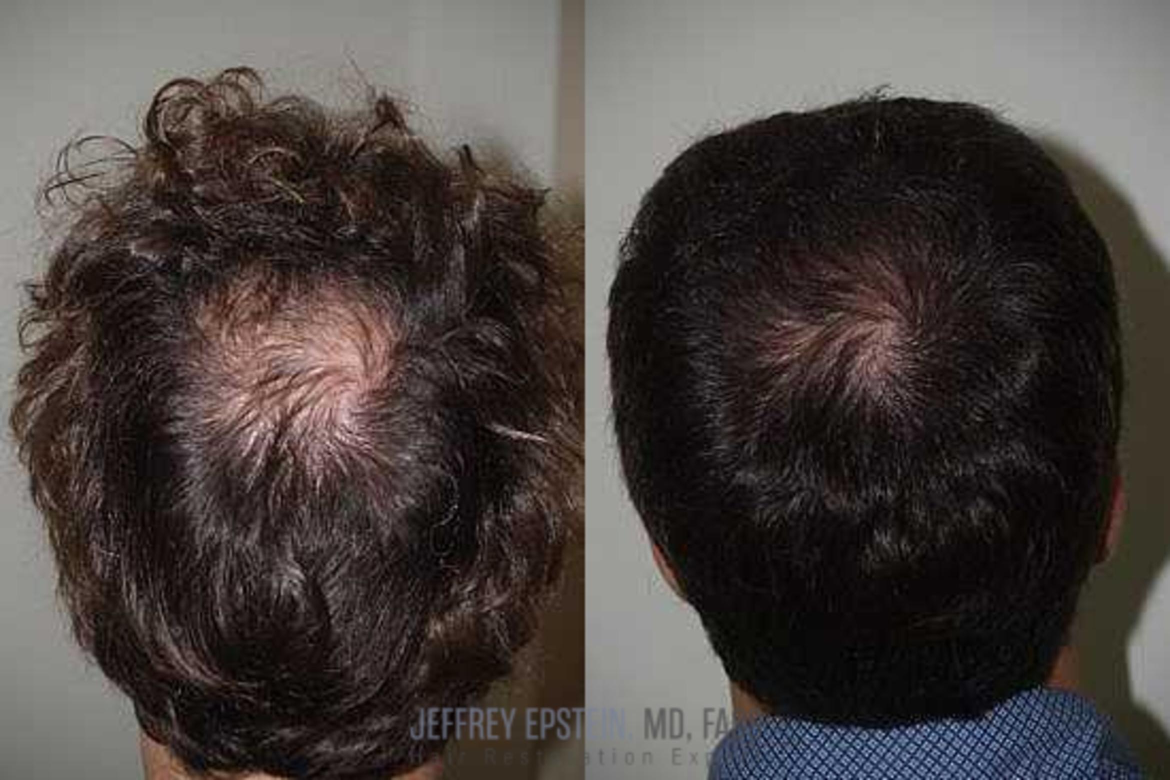 Before & After Hair Transplants For Men Case 106 View 1 View in Miami, FL