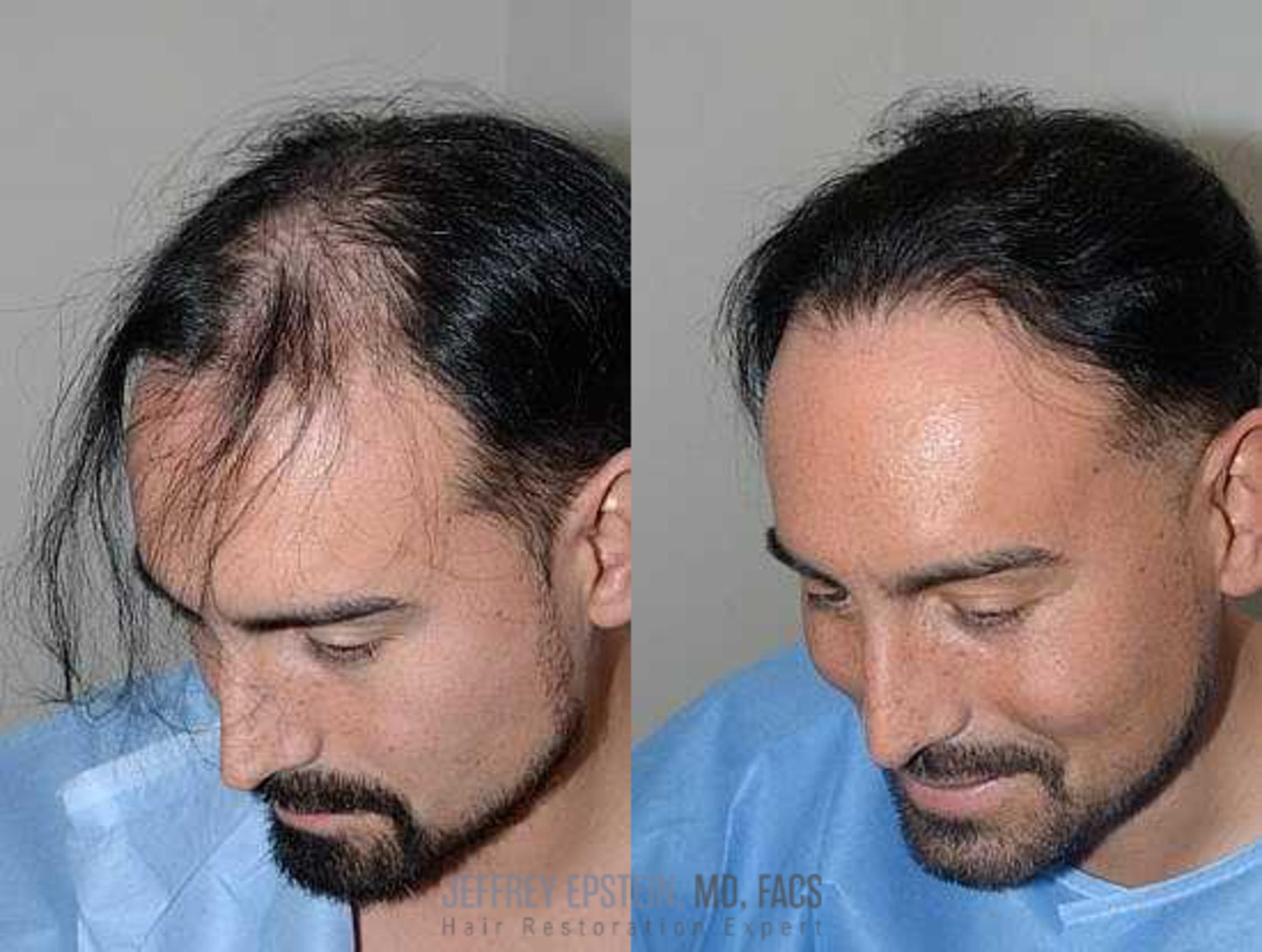 Before & After Hair Transplants For Men Case 107 View 1 View in Miami, FL