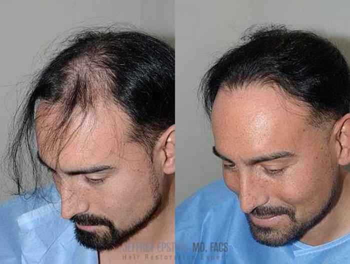 Before & After Hair Transplants For Men Case 107 View 1 View in Miami, FL