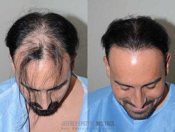 Before & After Hair Transplants For Men Case 107 View 2 View in Miami, FL