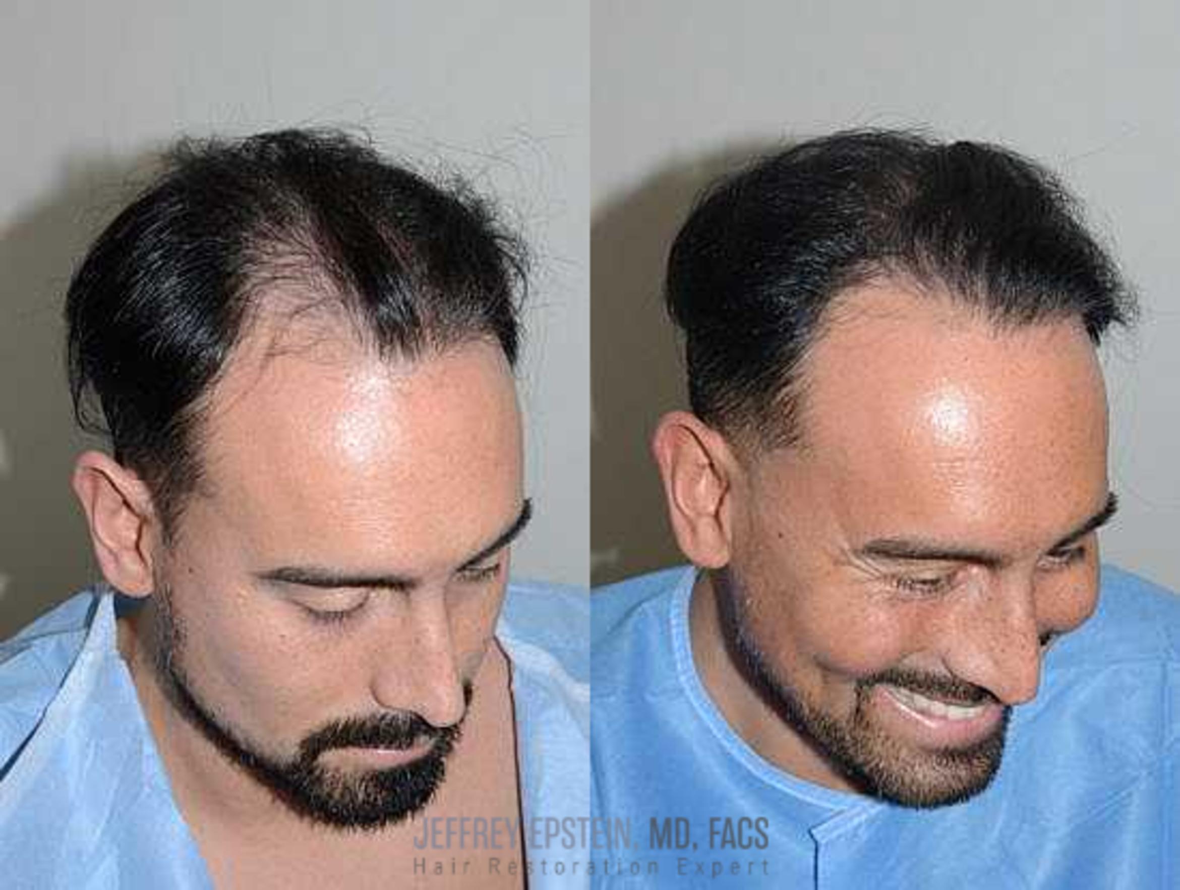 Before & After Hair Transplants For Men Case 107 View 3 View in Miami, FL