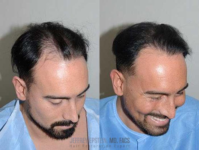 Before & After Hair Transplants For Men Case 107 View 3 View in Miami, FL