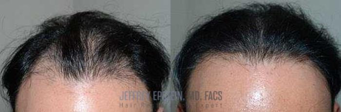 Before & After Hair Transplants For Men Case 107 View 4 View in Miami, FL