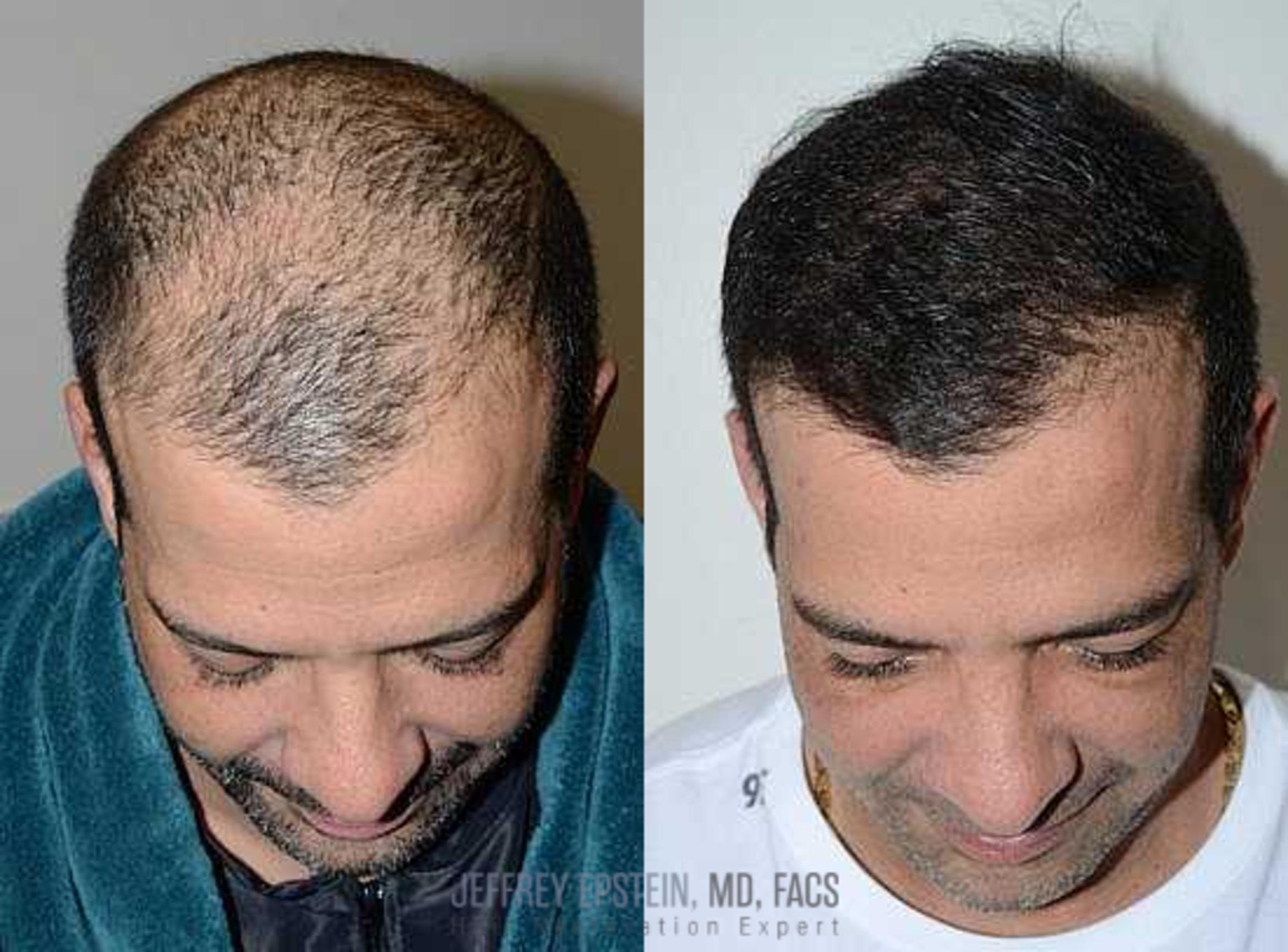 Before & After Hair Transplants For Men Case 108 View 1 View in Miami, FL