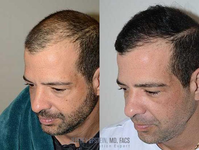 Before & After Hair Transplants For Men Case 108 View 2 View in Miami, FL