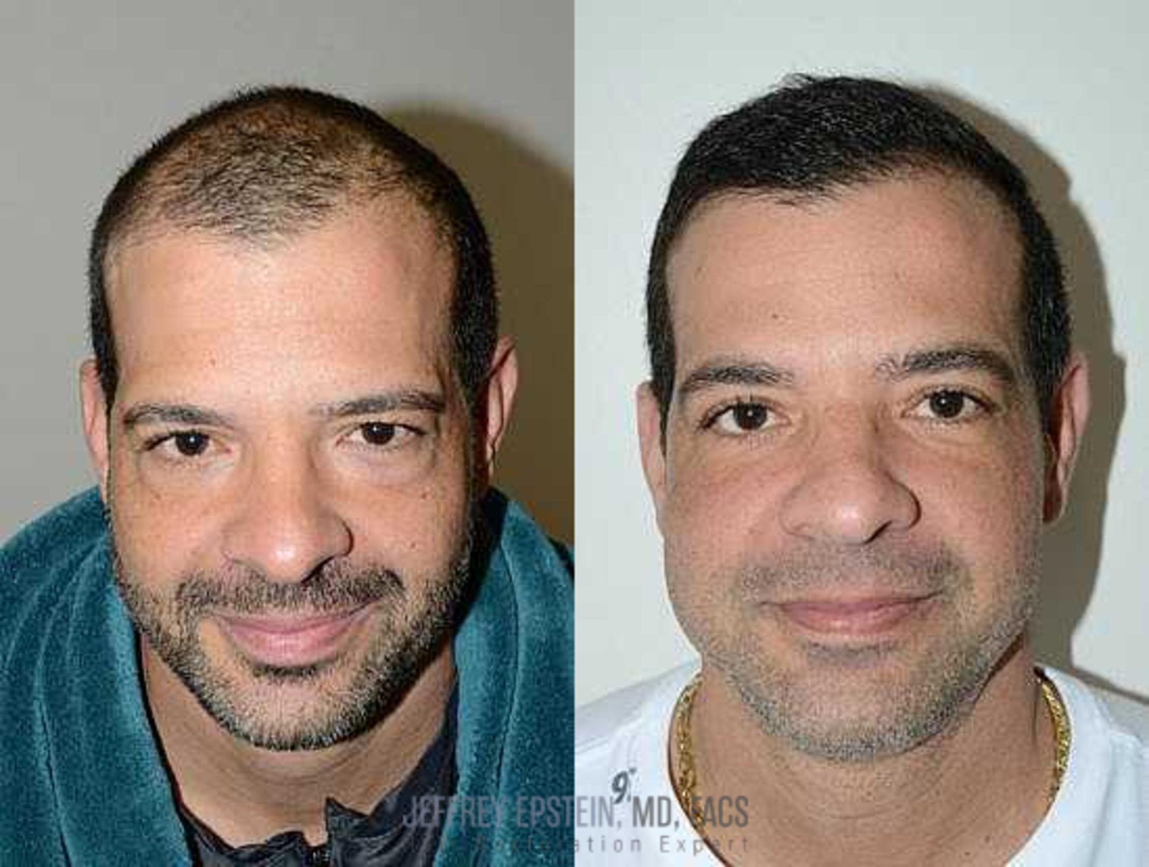 Before & After Hair Transplants For Men Case 108 View 3 View in Miami, FL