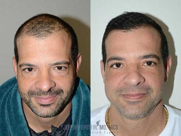 Before & After Hair Transplants For Men Case 108 View 3 View in Miami, FL