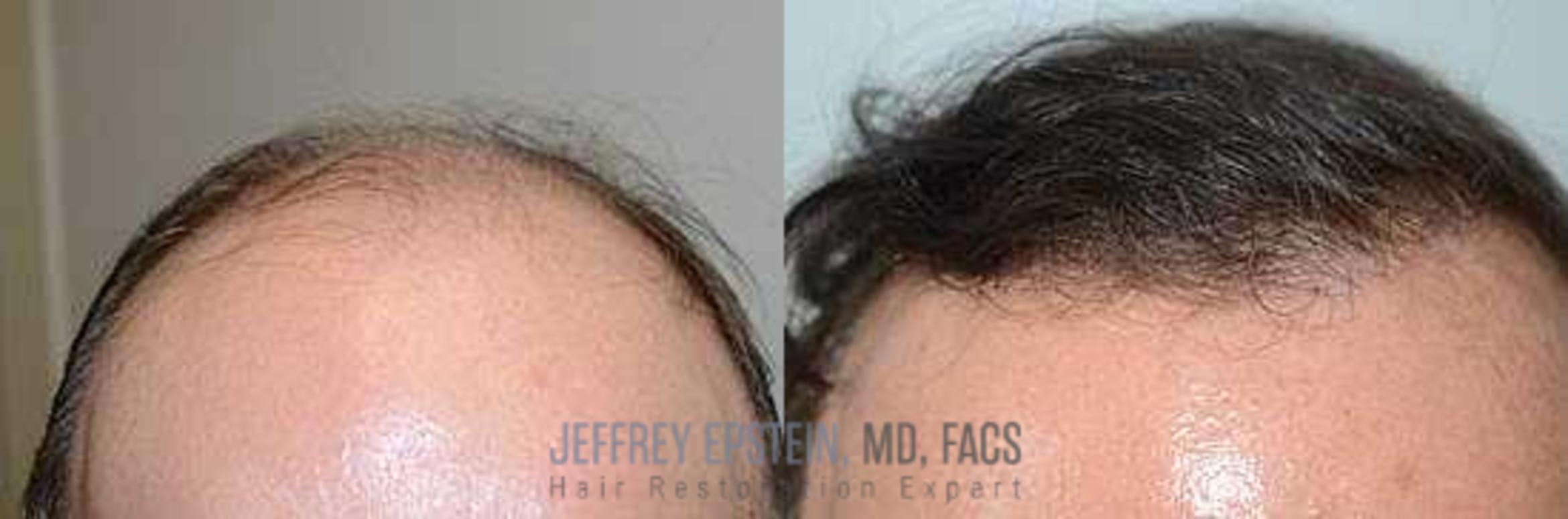 Before & After Hair Transplants For Men Case 109 View 1 View in Miami, FL
