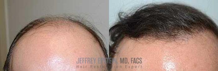 Before & After Body Hair Transplant (BHT) Case 109 View 1 View in Miami, FL