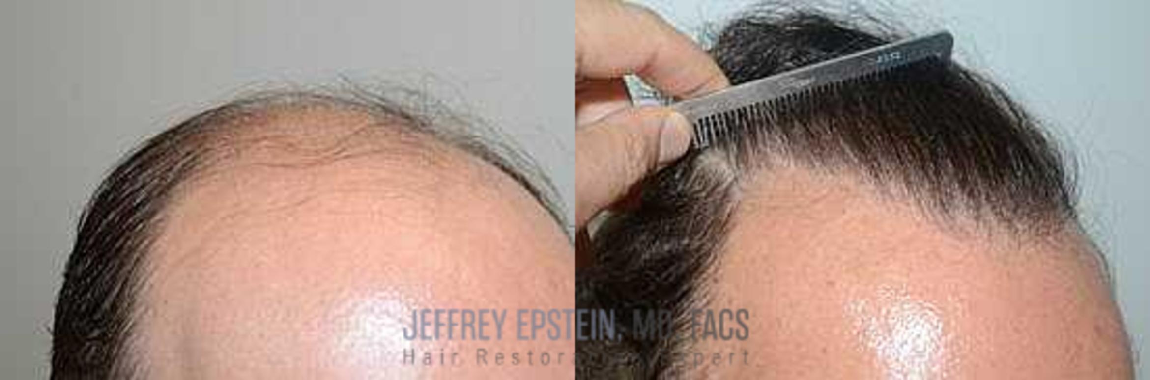Before & After Hair Transplants For Men Case 109 View 2 View in Miami, FL