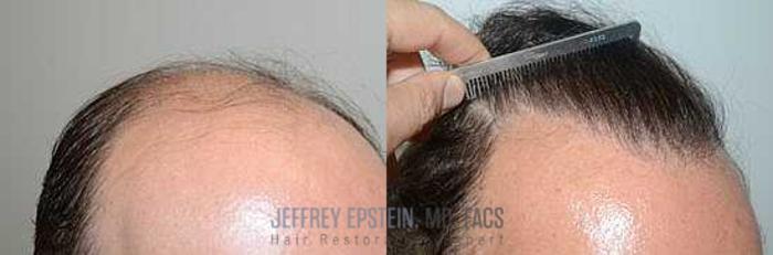 Before & After Hair Transplants For Men Case 109 View 2 View in Miami, FL