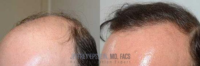Before & After Hair Transplants For Men Case 109 View 3 View in Miami, FL