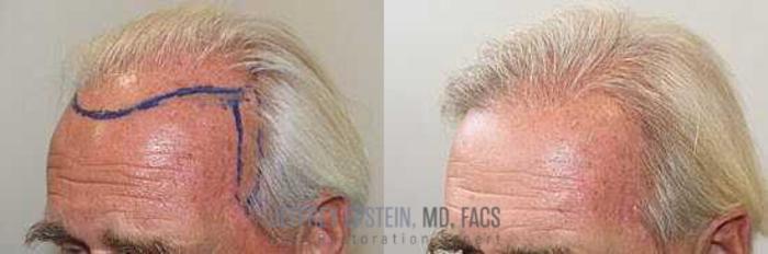 Before & After Hair Transplants For Men Case 11 View 1 View in Miami, FL