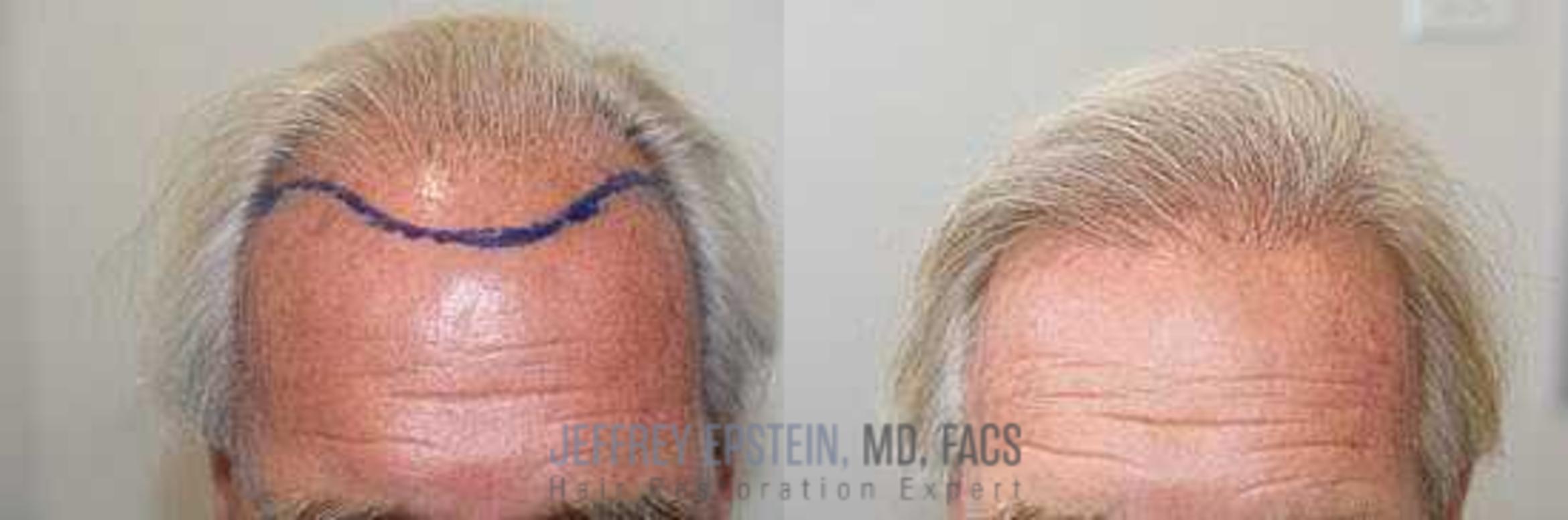 Before & After Hair Transplants For Men Case 11 View 2 View in Miami, FL
