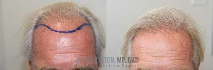 Before & After Hair Transplants For Men Case 11 View 2 View in Miami, FL