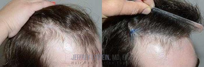 Before & After Hair Transplants For Men Case 110 View 1 View in Miami, FL