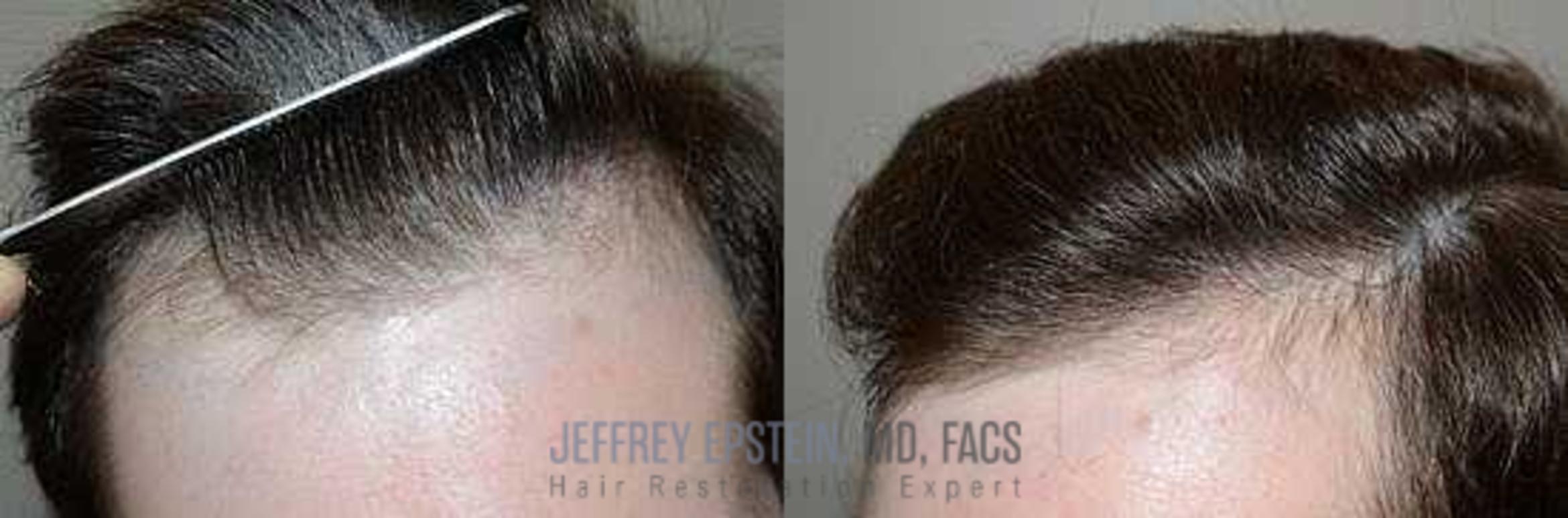 Before & After Hair Transplants For Men Case 110 View 2 View in Miami, FL
