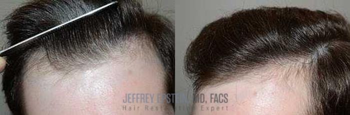 Before & After Hair Transplants For Men Case 110 View 2 View in Miami, FL
