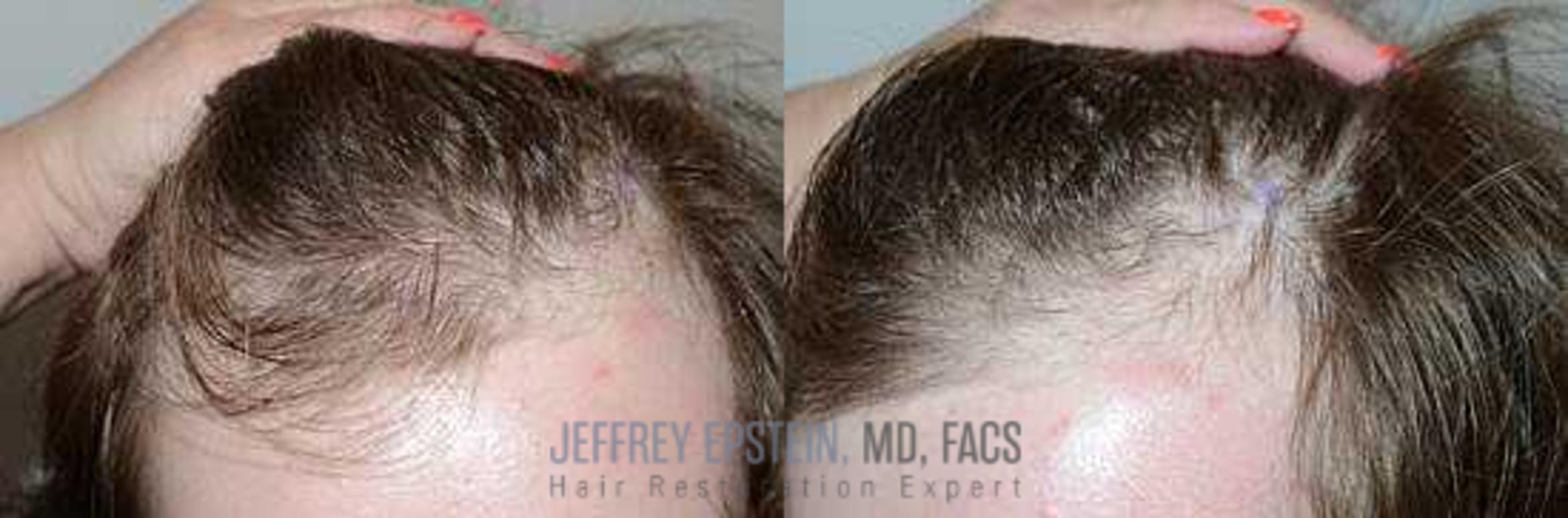 Before & After Hair Transplants For Men Case 110 View 3 View in Miami, FL