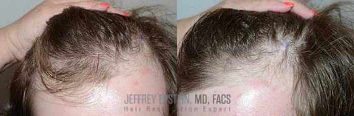 Before & After Hair Transplants For Men Case 110 View 3 View in Miami, FL