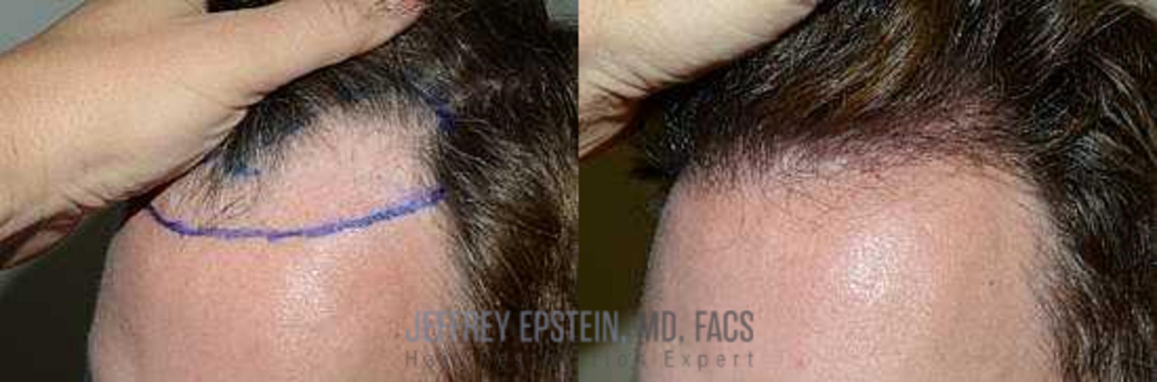 Before & After Hair Transplants For Men Case 111 View 1 View in Miami, FL