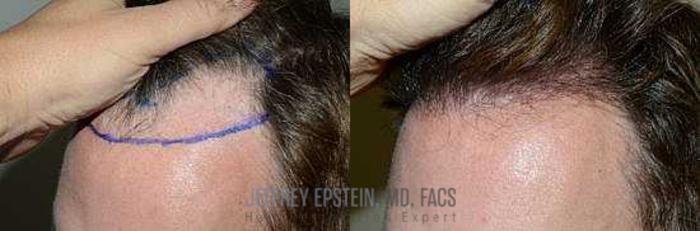 Before & After Hair Transplants For Men Case 111 View 1 View in Miami, FL