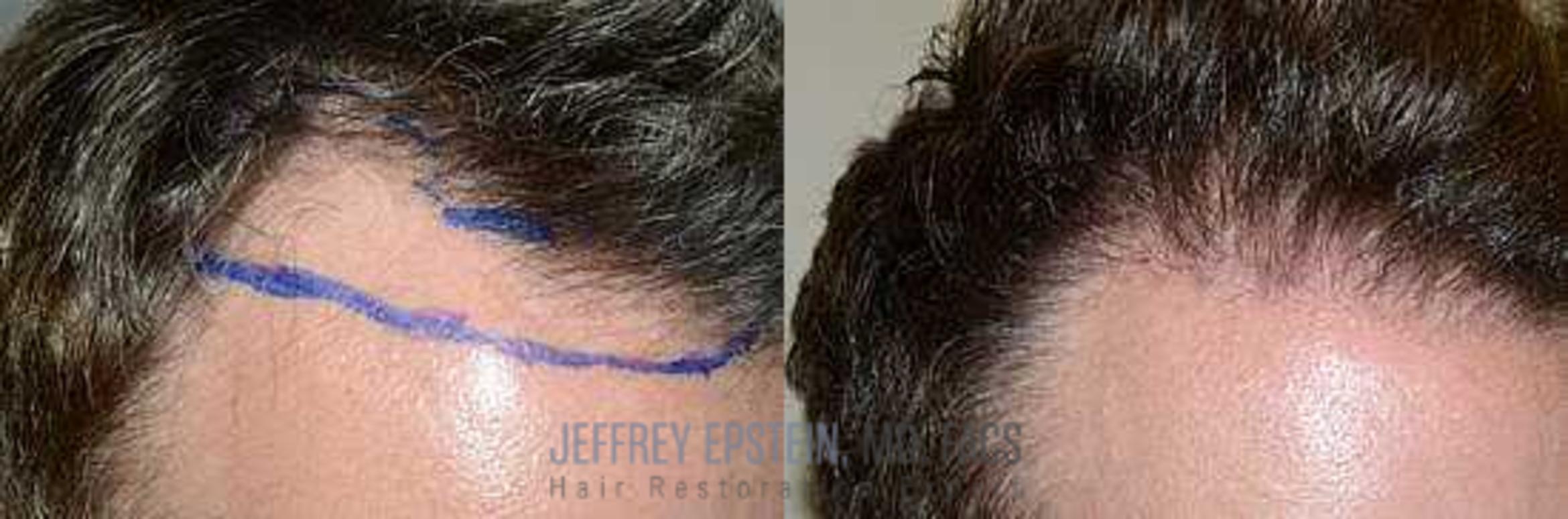 Before & After Hair Transplants For Men Case 111 View 2 View in Miami, FL