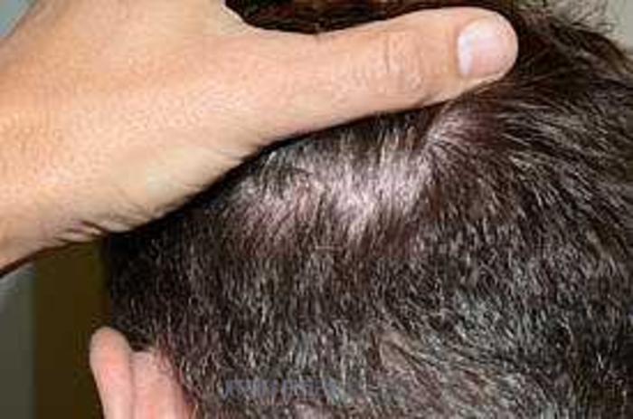Before & After Hair Transplants For Men Case 111 View 3 View in Miami, FL