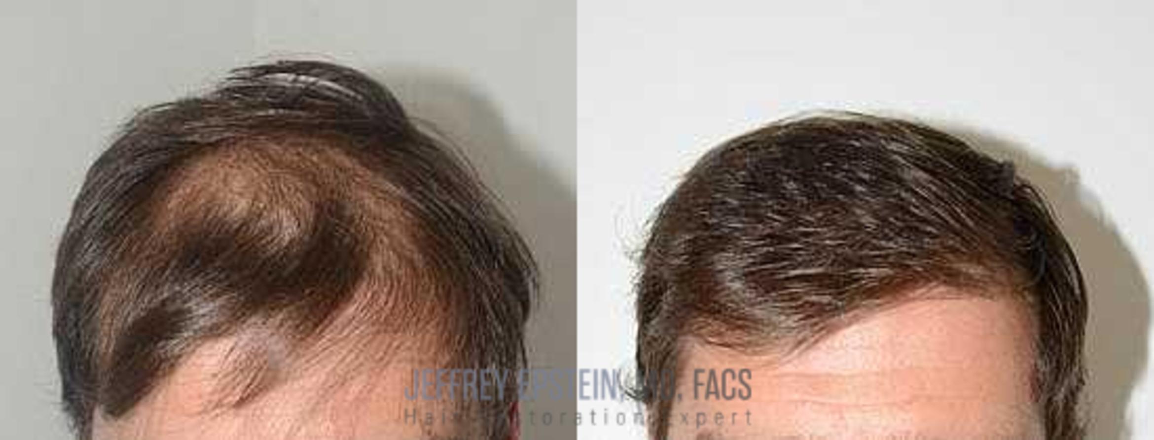 Before & After Hair Transplants For Men Case 113 View 1 View in Miami, FL
