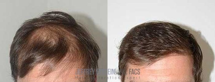 Before & After Hair Transplants For Men Case 113 View 1 View in Miami, FL