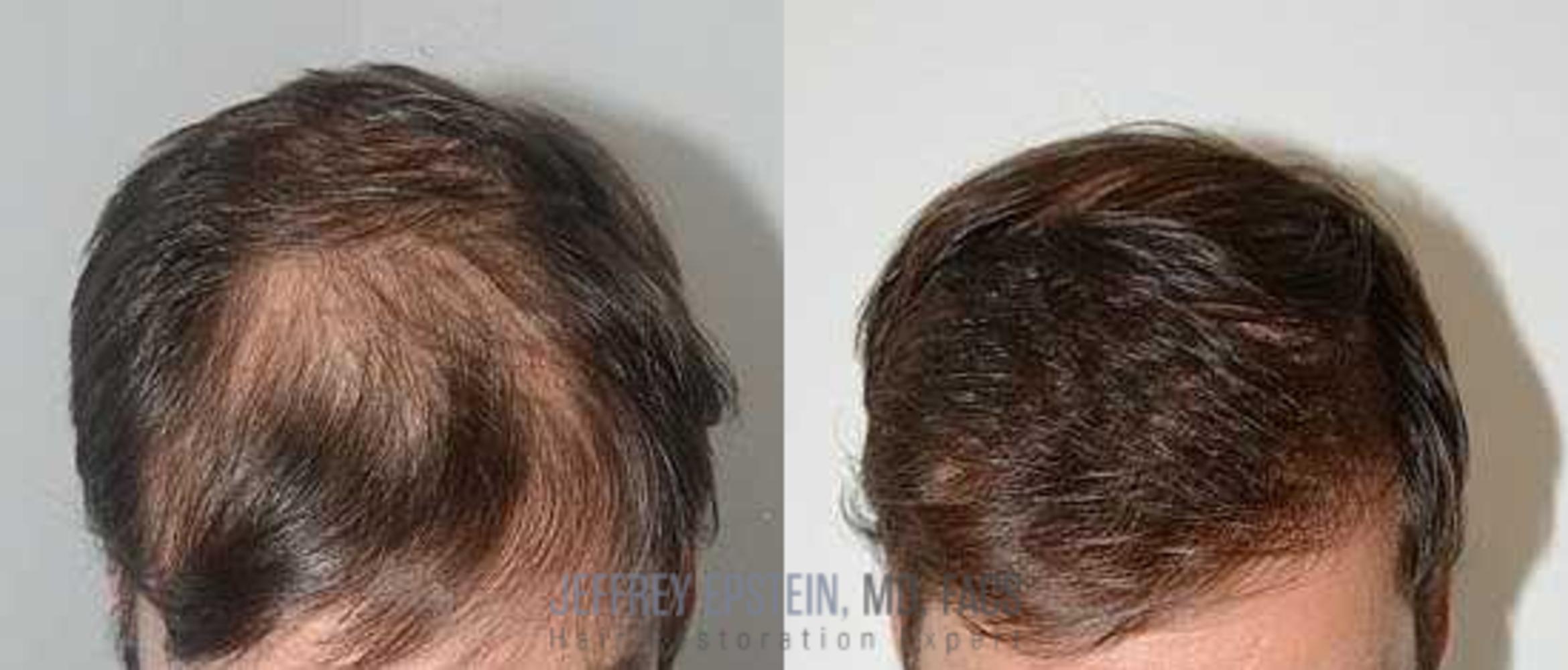 Before & After Hair Transplants For Men Case 113 View 2 View in Miami, FL