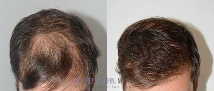 Before & After Hair Transplants For Men Case 113 View 2 View in Miami, FL