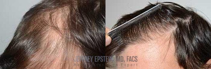 Before & After Hair Transplants For Men Case 113 View 3 View in Miami, FL