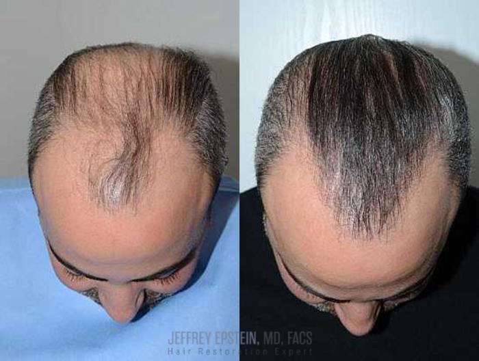 Before & After Hair Transplants For Men Case 114 View 1 View in Miami, FL