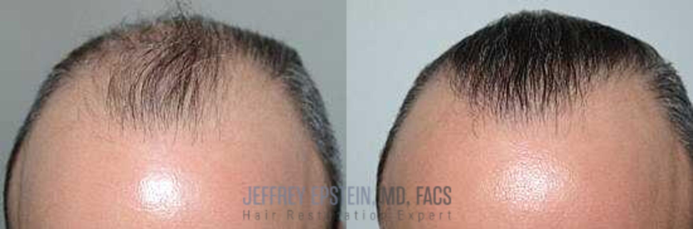 Before & After Hair Transplants For Men Case 114 View 2 View in Miami, FL