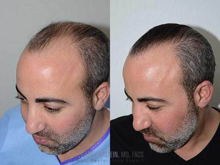 Before & After Hair Transplants For Men Case 114 View 3 View in Miami, FL