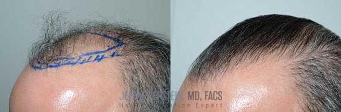 Before & After Hair Transplants For Men Case 114 View 4 View in Miami, FL