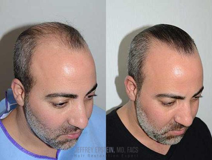 Before & After Hair Transplants For Men Case 114 View 5 View in Miami, FL