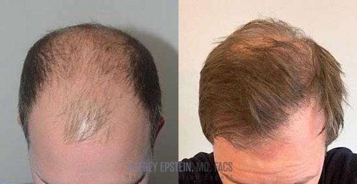 Before & After Hair Transplants For Men Case 115 View 1 View in Miami, FL