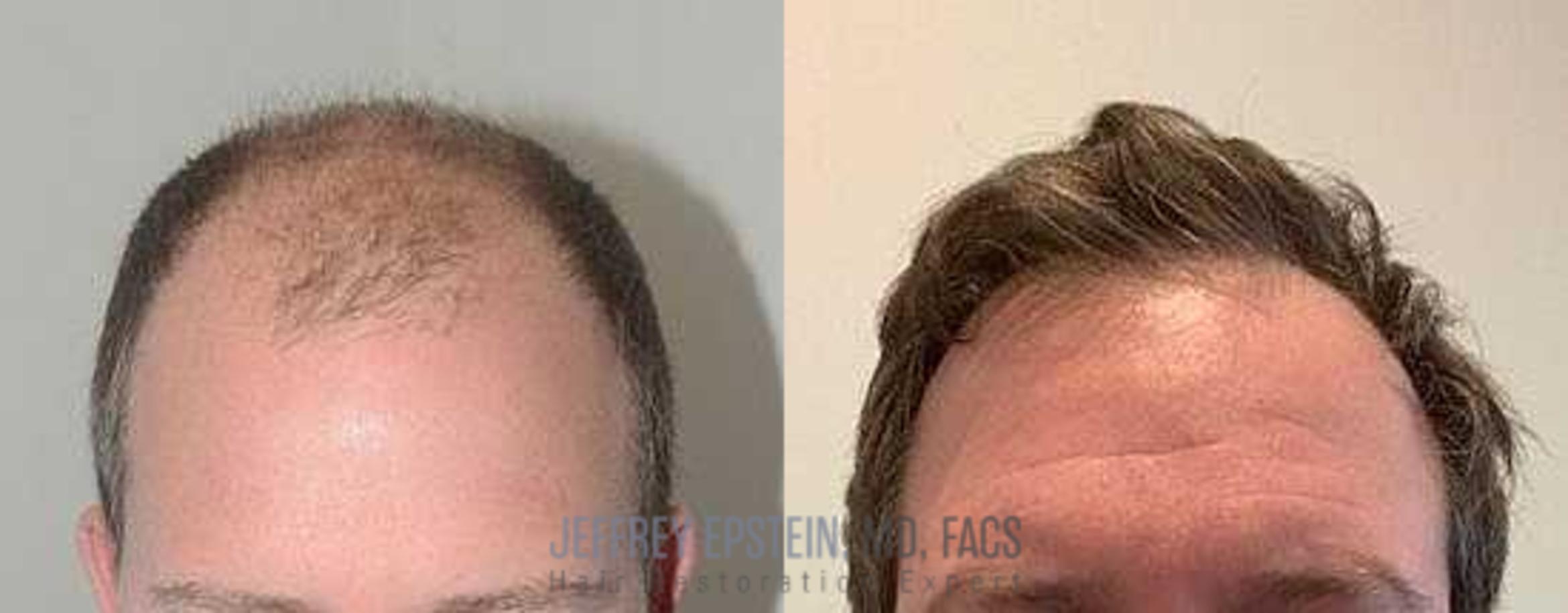 Before & After Hair Transplants For Men Case 115 View 2 View in Miami, FL
